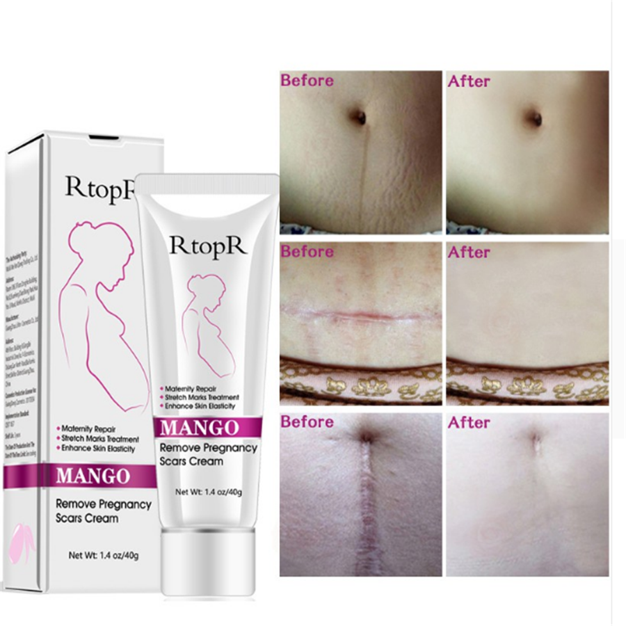 Mango Antenatal Cream - RtopR Body Cream